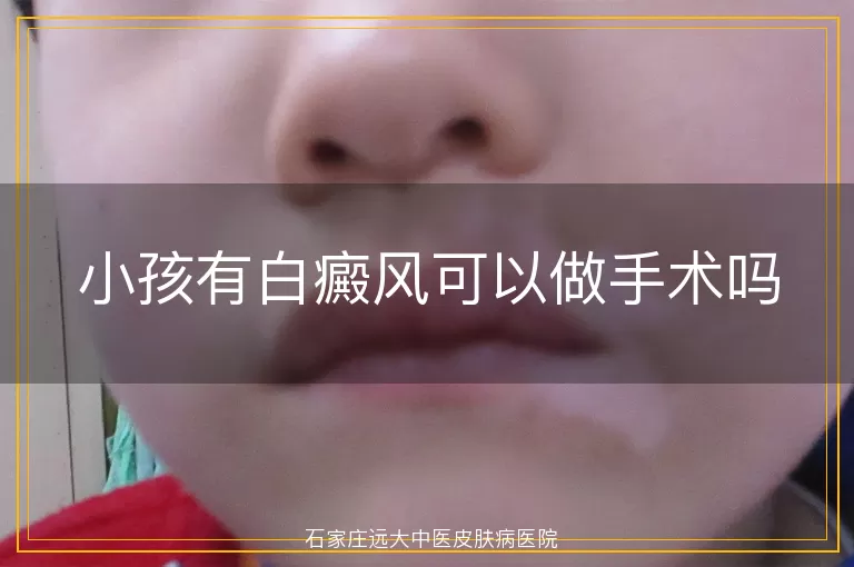 小孩有白癜风可以做手术吗