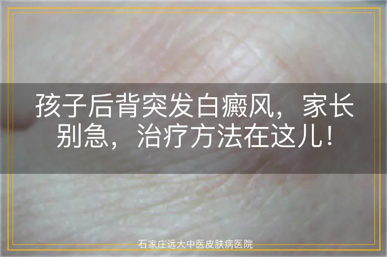 孩子后背突发白癜风，家长别急，治疗方法在这儿！