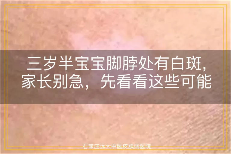 三岁半宝宝脚脖处有白斑，家长别急，先看看这些可能的原因