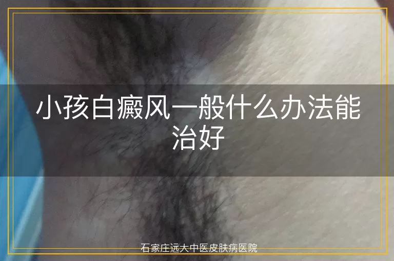 小孩白癜风一般什么办法能治好