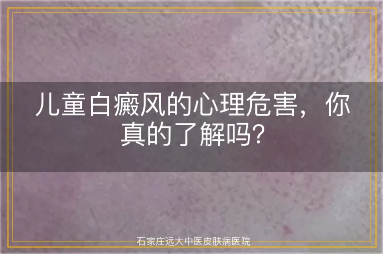 儿童白癜风的心理危害，你真的了解吗？