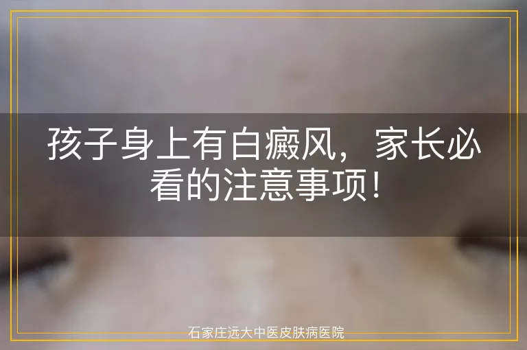 孩子身上有白癜风，家长必看的注意事项！
