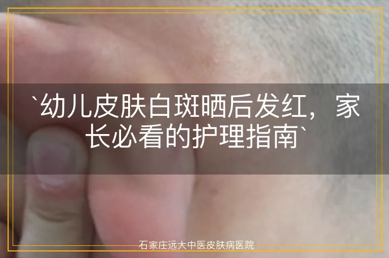 幼儿皮肤白斑晒后发红，家长必看的护理指南