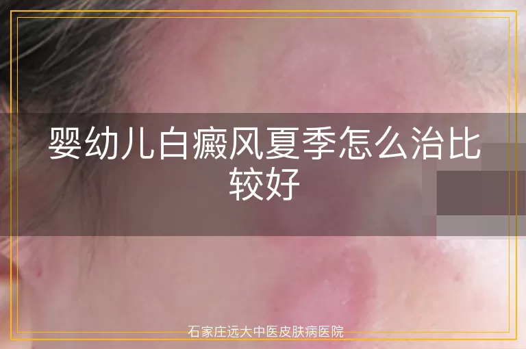 婴幼儿白癜风夏季怎么治比较好