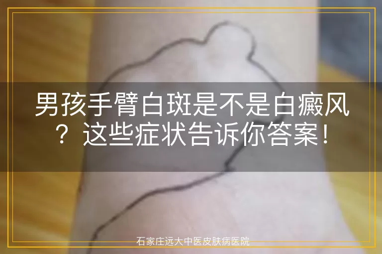男孩手臂白斑是不是白癜风？这些症状告诉你答案！
