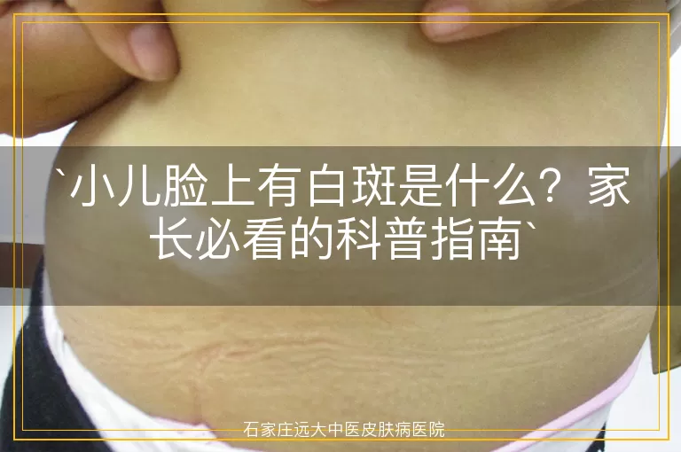 小儿脸上有白斑是什么？家长必看的科普指南