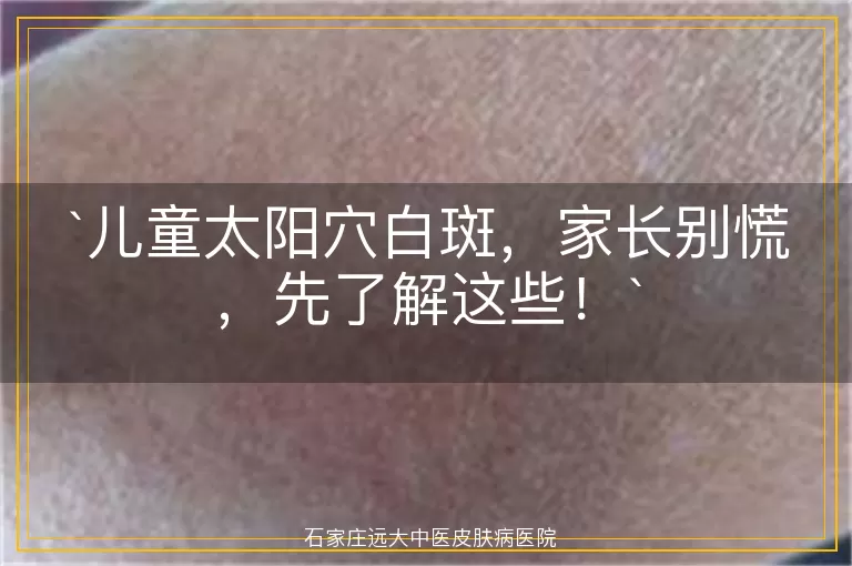 儿童太阳穴白斑，家长别慌，先了解这些！