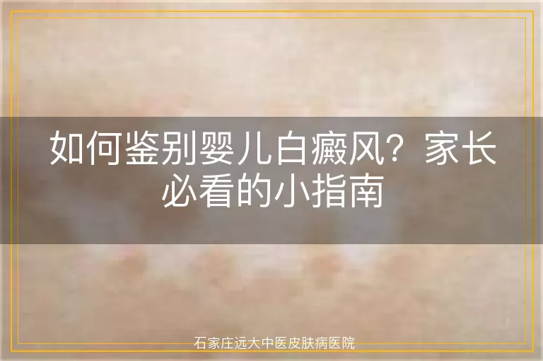 如何鉴别婴儿白癜风？家长必看的小指南