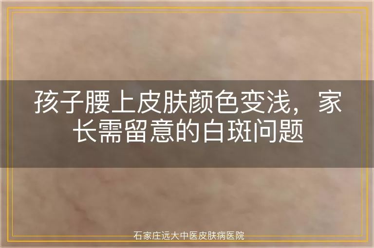 孩子腰上皮肤颜色变浅,家长需留意的白斑问题