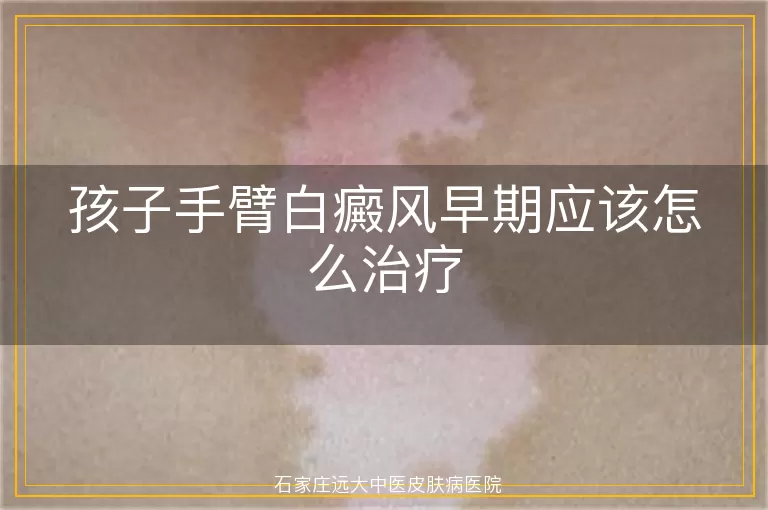孩子手臂白癜风早期应该怎么治疗