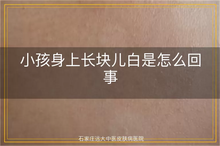 小孩身上长块儿白是怎么回事