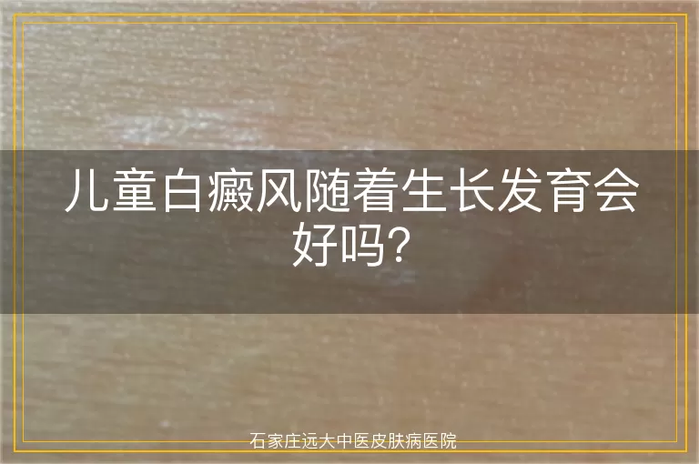 儿童白癜风随着生长发育会好吗？