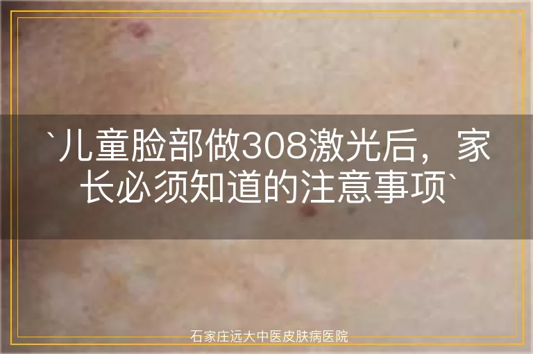 儿童脸部做308激光后，家长必须知道的注意事项