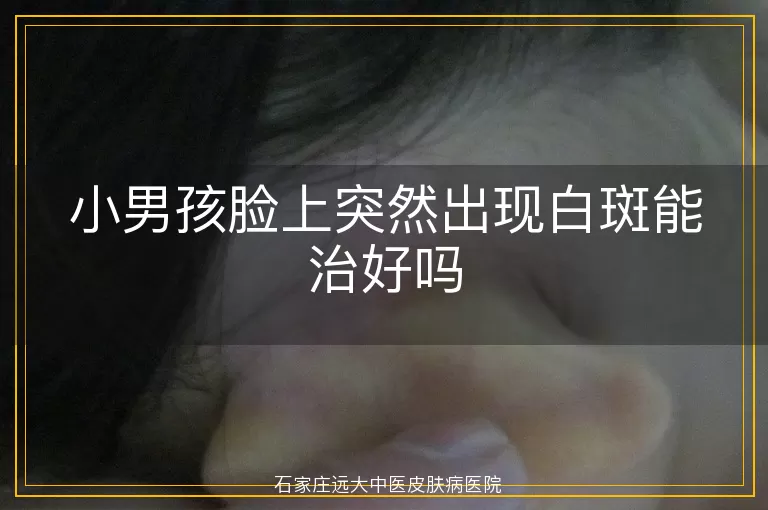 小男孩脸上突然出现白斑能治好吗