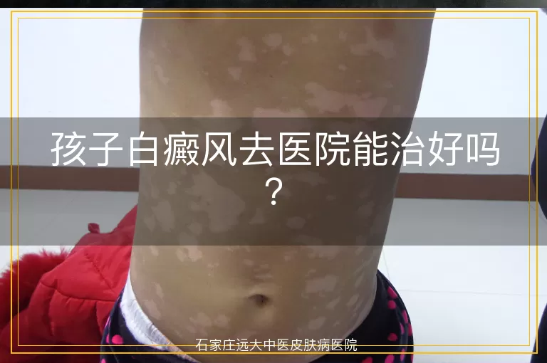 孩子白癜风去医院能治好吗？