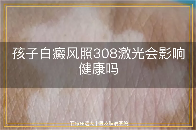 孩子白癜风照308激光会影响健康吗