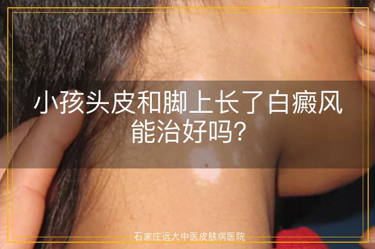 小孩头皮和脚上长了白癜风能治好吗？