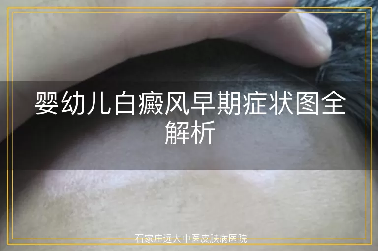 婴幼儿白癜风早期症状图全解析