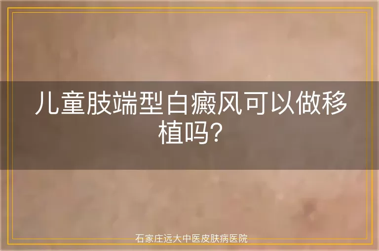 儿童肢端型白癜风可以做移植吗？
