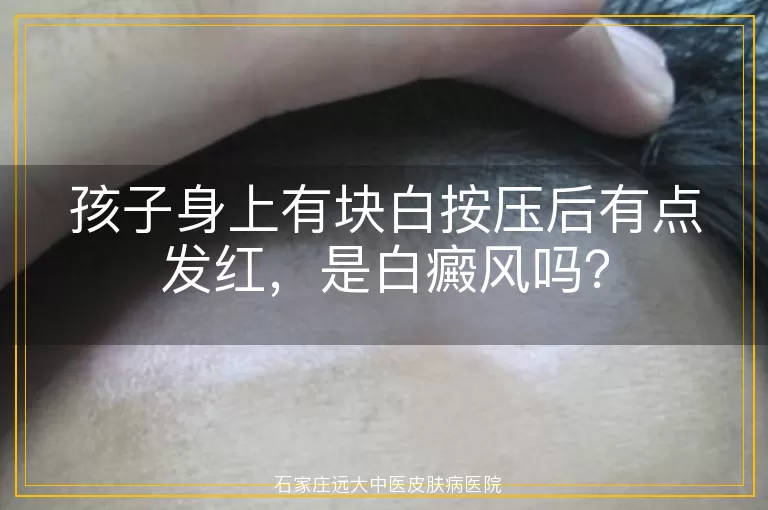 孩子身上有块白按压后有点发红，是白癜风吗？