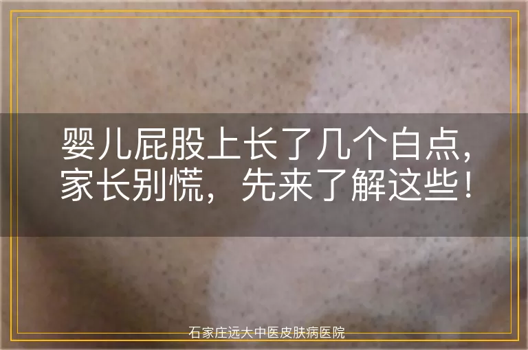 婴儿屁股上长了几个白点，家长别慌，先来了解这些！