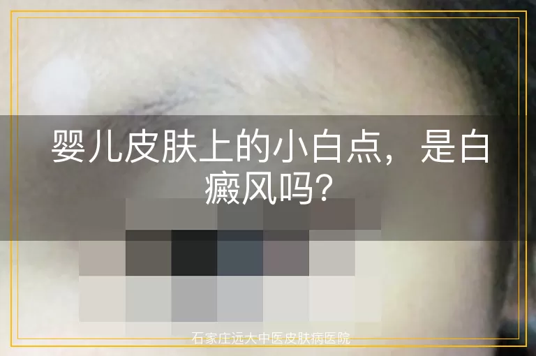 婴儿皮肤上的小白点，是白癜风吗？