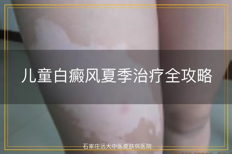 儿童白癜风夏季治疗全攻略
