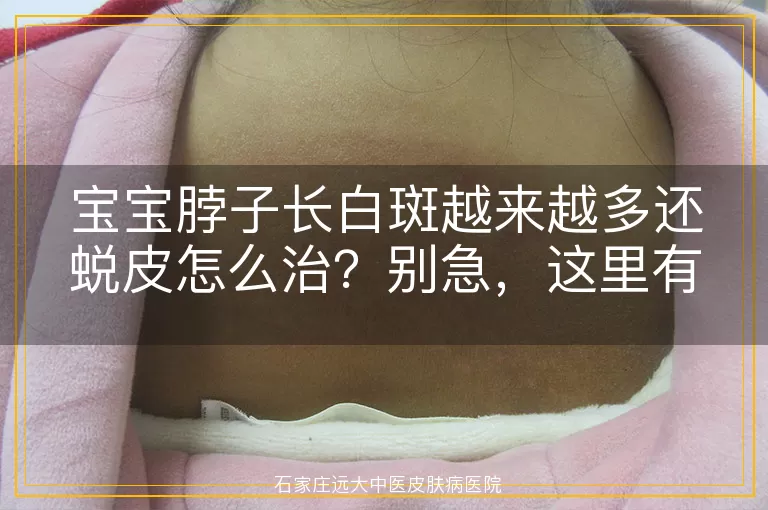 宝宝脖子长白斑越来越多还蜕皮怎么治？别急，这里有招！
