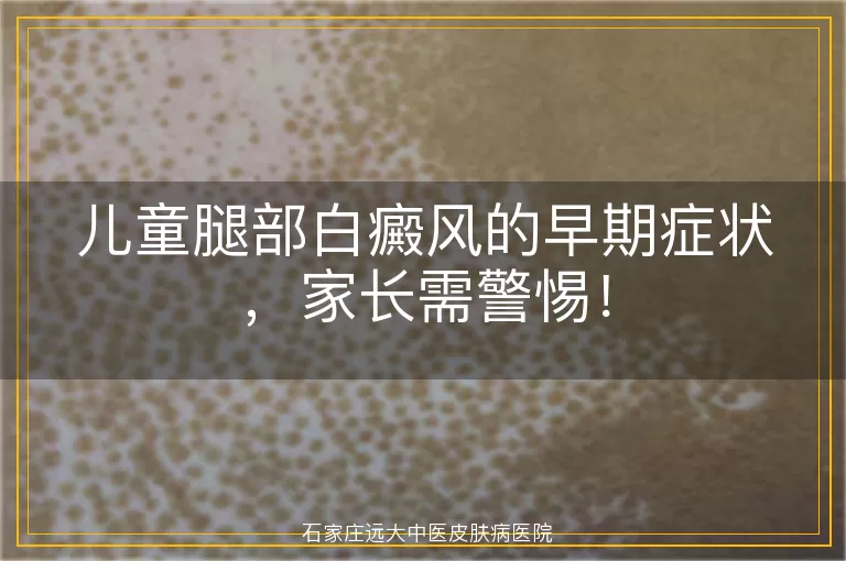 儿童腿部白癜风的早期症状，家长需警惕！