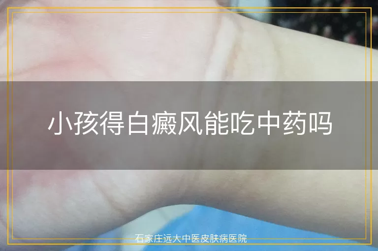 小孩得白癜风能吃中药吗