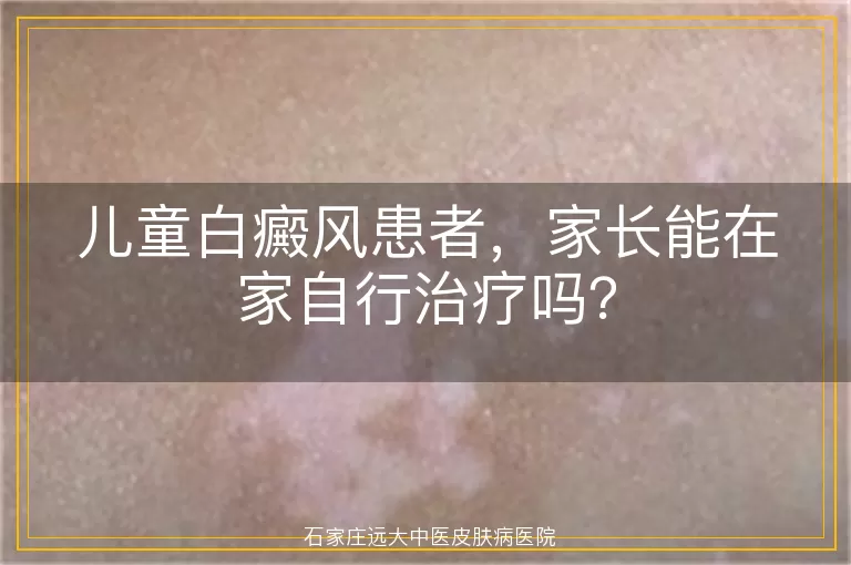 儿童白癜风患者，家长能在家自行治疗吗？