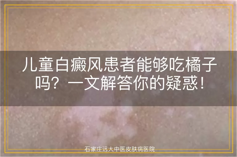 儿童白癜风患者能够吃橘子吗？一文解答你的疑惑！