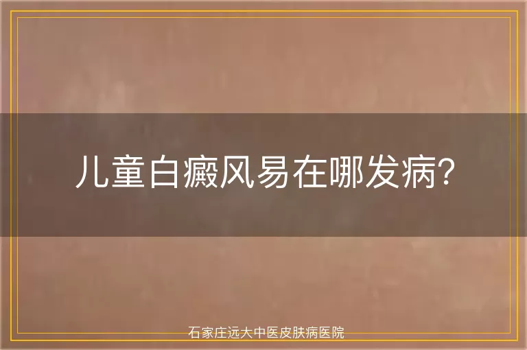 儿童白癜风易在哪发病？