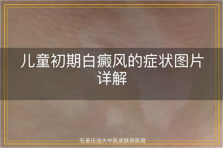儿童初期白癜风的症状图片详解
