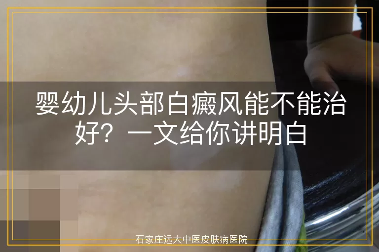 婴幼儿头部白癜风能不能治好？一文给你讲明白
