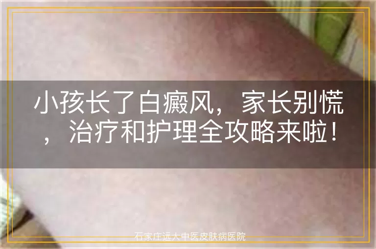小孩长了白癜风，家长别慌，治疗和护理全攻略来啦！