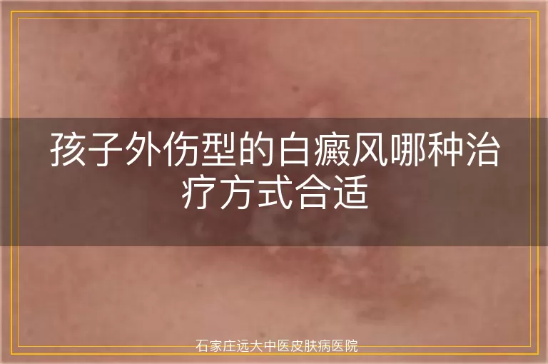 孩子外伤型的白癜风哪种治疗方式合适