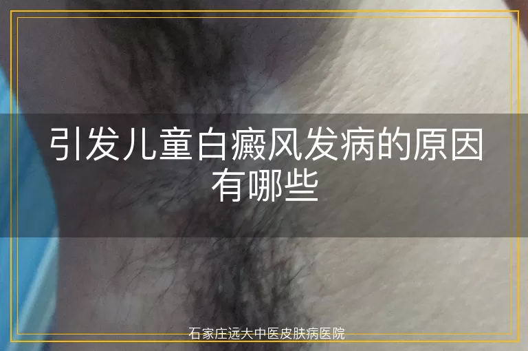 引发儿童白癜风发病的原因有哪些