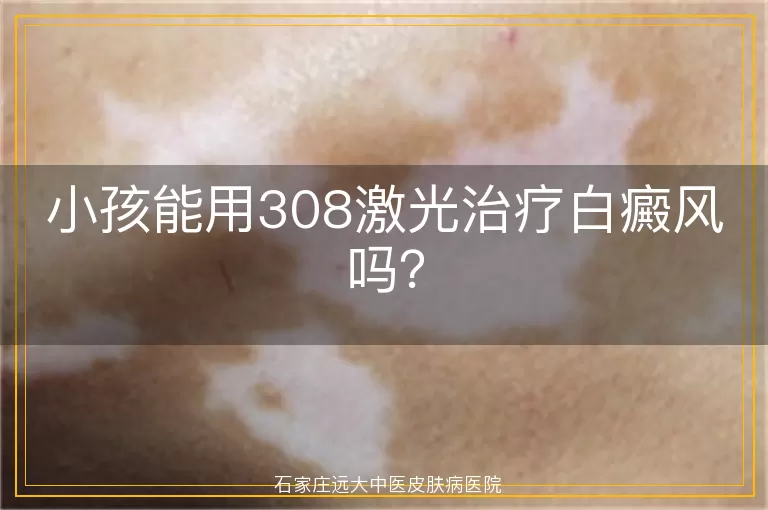 小孩能用308激光治疗白癜风吗？