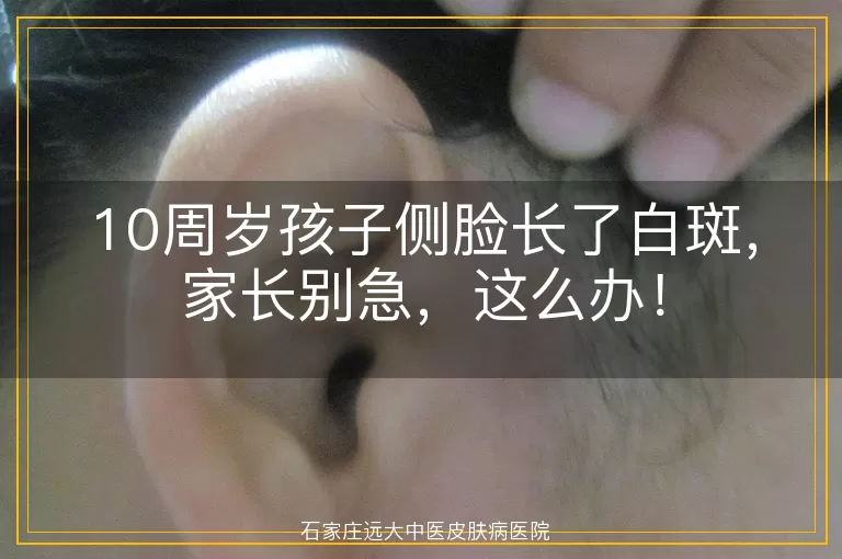 10周岁孩子侧脸长了白斑，家长别急，这么办！