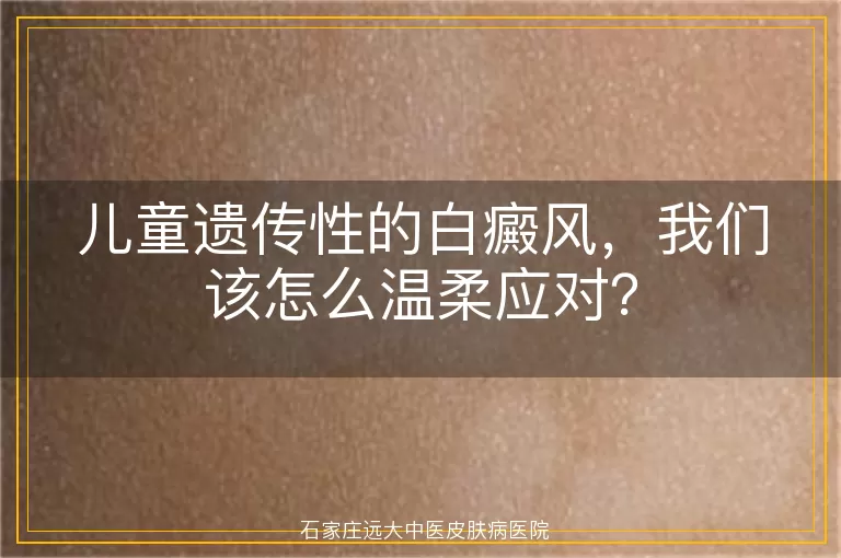 儿童遗传性的白癜风，我们该怎么温柔应对？