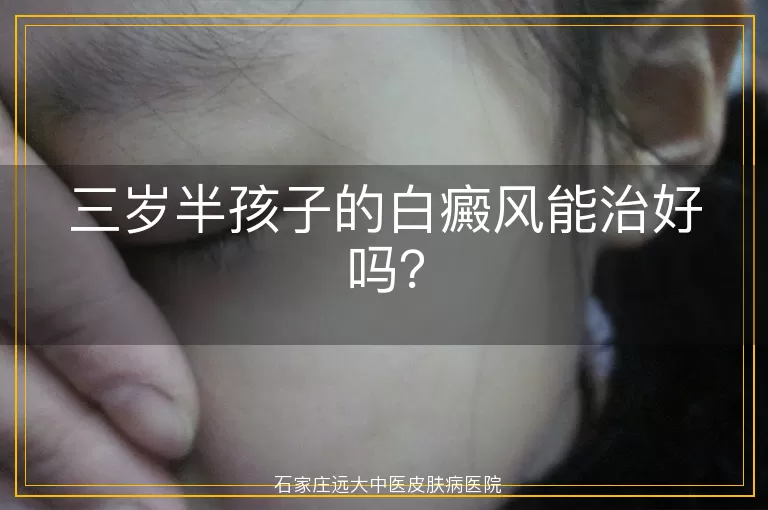 三岁半孩子的白癜风能治好吗？