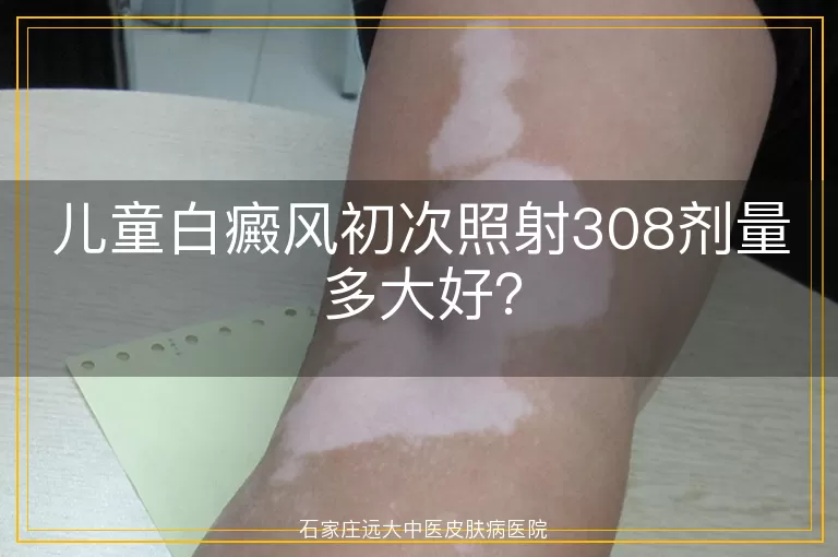 儿童白癜风初次照射308剂量多大好？