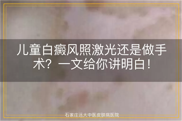 儿童白癜风照激光还是做手术？一文给你讲明白！