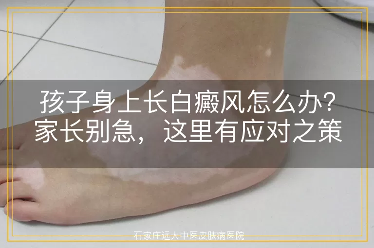 孩子身上长白癜风怎么办？家长别急，这里有应对之策！