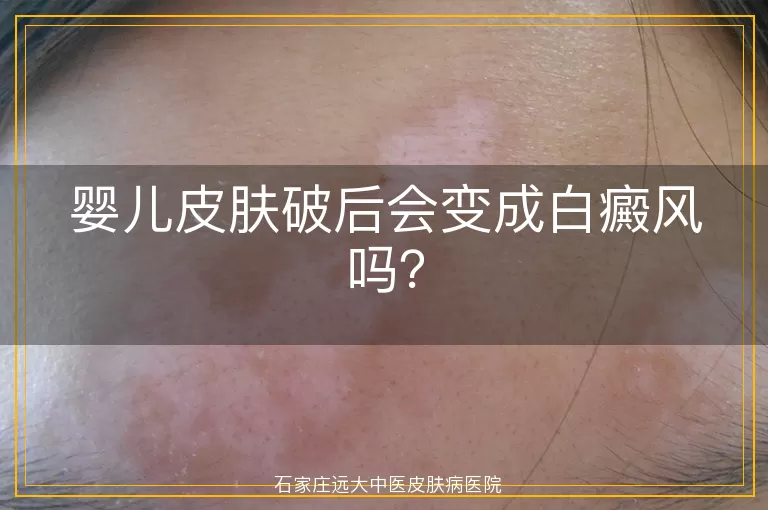 婴儿皮肤破后会变成白癜风吗？