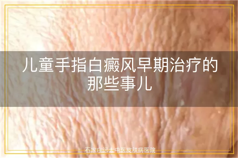 儿童手指白癜风早期治疗的那些事儿