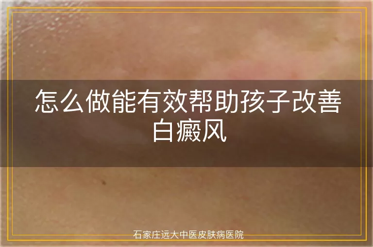 怎么做能有效帮助孩子改善白癜风
