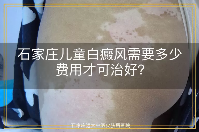 石家庄儿童白癜风需要多少费用才可治好？