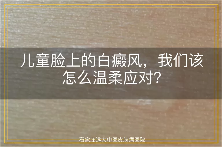 儿童脸上的白癜风，我们该怎么温柔应对？